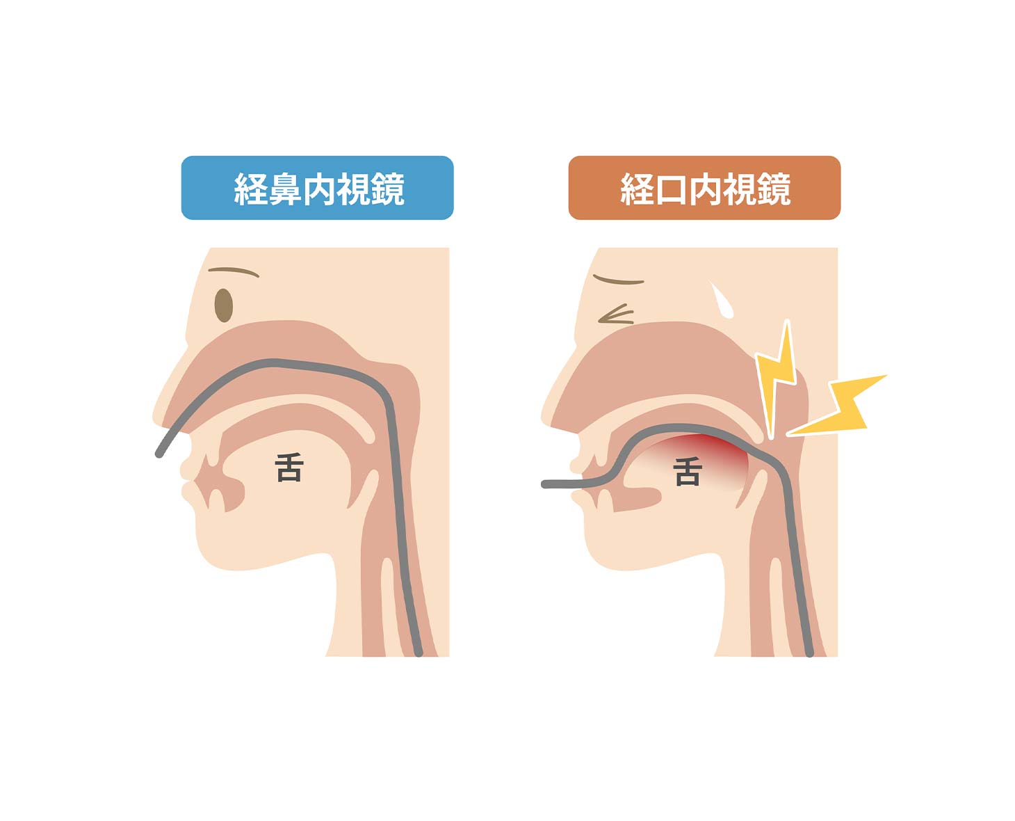 検査中の苦痛に配慮し、経鼻内視鏡を導入