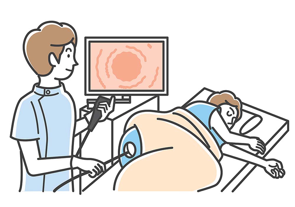 下部消化管内視鏡検査（大腸カメラ）