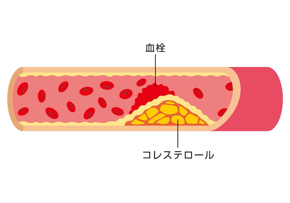 脂質異常症